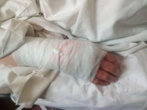 Лікарям вдалося зберегти руки жінці, на яку в Ірпені напав власний пес