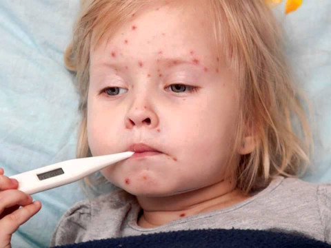 У Броварах далі "гуляє" вітряна віспа