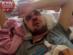 Водій боярської маршрутки побив пасажира: медики діагностували множинні переломи черепа (ФОТО)