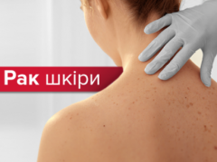 У Білій Церкві лікарі проведуть безкоштовне обстеження на рак шкіри
