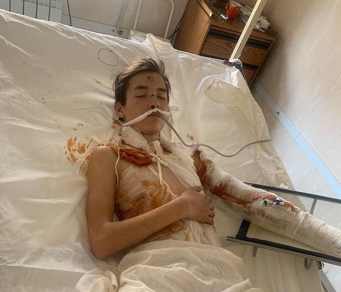 Неповнолітній із Ірпеня потребує допомоги після ураження високовольтним струмом